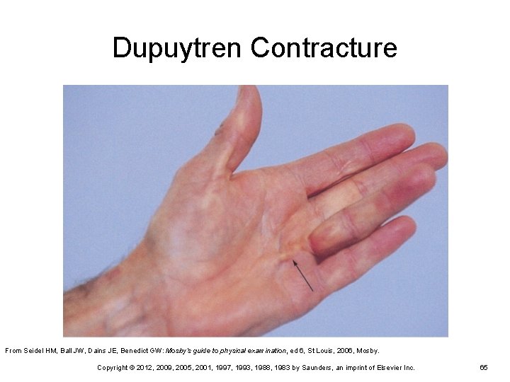 Dupuytren Contracture From Seidel HM, Ball JW, Dains JE, Benedict GW: Mosby’s guide to Dupuytren Contracture From Seidel HM, Ball JW, Dains JE, Benedict GW: Mosby’s guide to