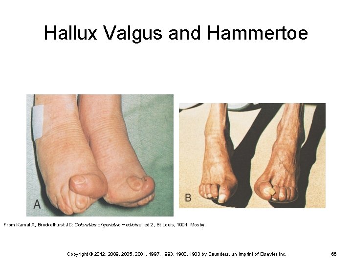 Hallux Valgus and Hammertoe From Kamal A, Brockelhurst JC: Coloratlas of geriatric medicine, ed Hallux Valgus and Hammertoe From Kamal A, Brockelhurst JC: Coloratlas of geriatric medicine, ed