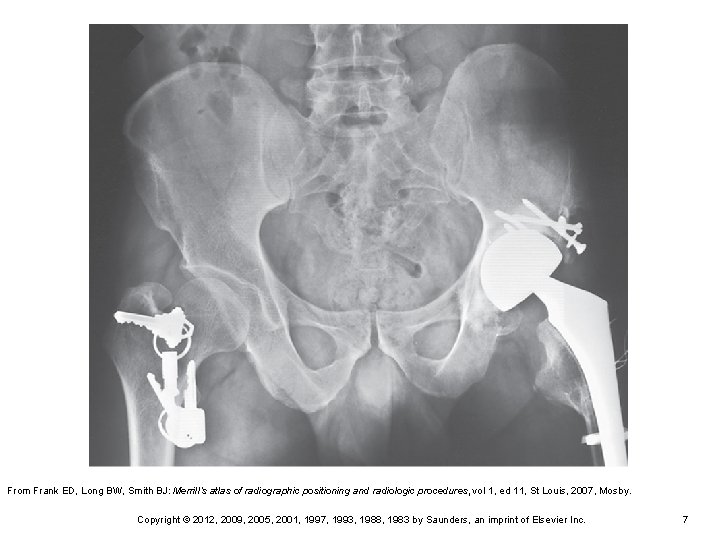 From Frank ED, Long BW, Smith BJ: Merrill’s atlas of radiographic positioning and radiologic From Frank ED, Long BW, Smith BJ: Merrill’s atlas of radiographic positioning and radiologic