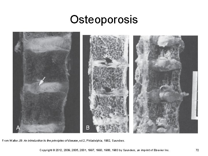 Osteoporosis From Walter JB: An introduction to the principles of disease, ed 2, Philadelphia, Osteoporosis From Walter JB: An introduction to the principles of disease, ed 2, Philadelphia,