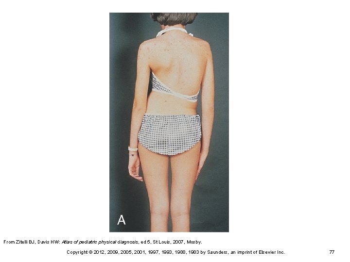 From Zitelli BJ, Davis HW: Atlas of pediatric physical diagnosis, ed 5, St Louis, From Zitelli BJ, Davis HW: Atlas of pediatric physical diagnosis, ed 5, St Louis,