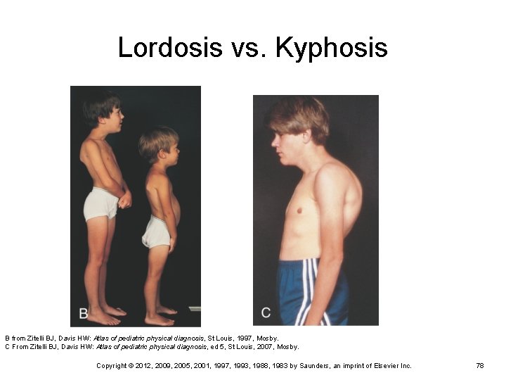 Lordosis vs. Kyphosis B from Zitelli BJ, Davis HW: Atlas of pediatric physical diagnosis, Lordosis vs. Kyphosis B from Zitelli BJ, Davis HW: Atlas of pediatric physical diagnosis,