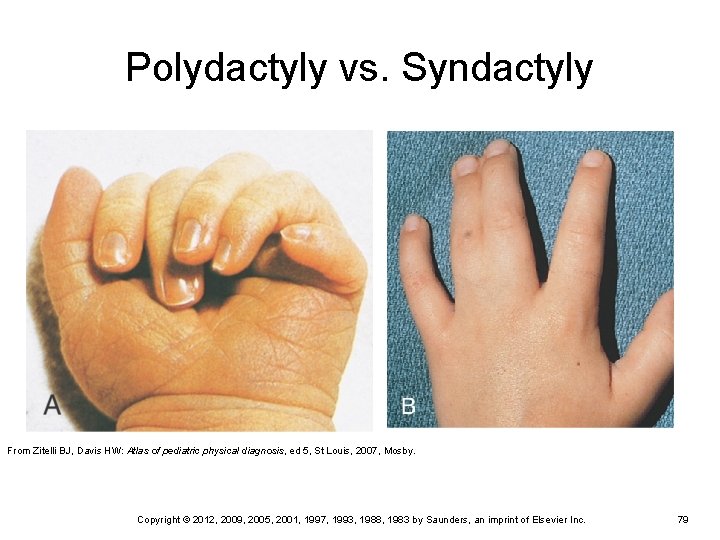Polydactyly vs. Syndactyly From Zitelli BJ, Davis HW: Atlas of pediatric physical diagnosis, ed Polydactyly vs. Syndactyly From Zitelli BJ, Davis HW: Atlas of pediatric physical diagnosis, ed