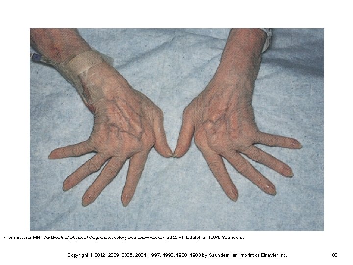 From Swartz MH: Textbook of physical diagnosis: history and examination, ed 2, Philadelphia, 1994, From Swartz MH: Textbook of physical diagnosis: history and examination, ed 2, Philadelphia, 1994,
