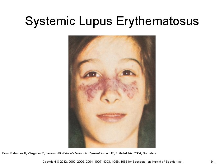 Systemic Lupus Erythematosus From Behrman R, Kliegman R, Jenson HB: Nelson’s textbook of pediatrics, Systemic Lupus Erythematosus From Behrman R, Kliegman R, Jenson HB: Nelson’s textbook of pediatrics,