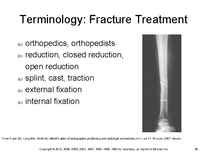 Terminology: Fracture Treatment orthopedics, orthopedists reduction, closed reduction, open reduction splint, cast, traction external Terminology: Fracture Treatment orthopedics, orthopedists reduction, closed reduction, open reduction splint, cast, traction external