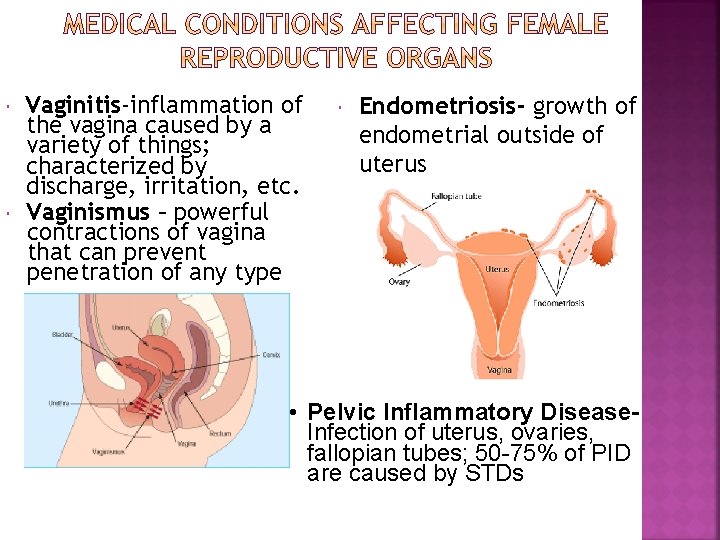  Vaginitis-inflammation of the vagina caused by a variety of things; characterized by discharge,