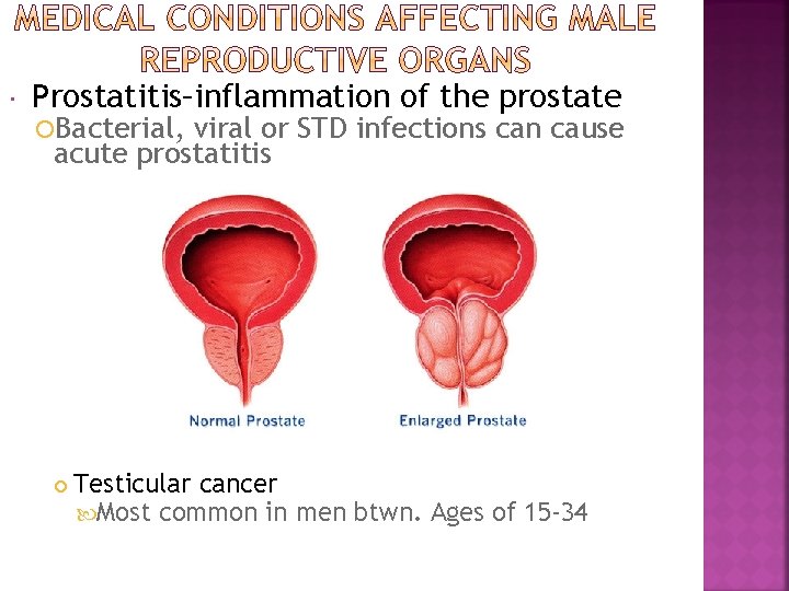  Prostatitis–inflammation of the prostate Bacterial, viral or STD infections can cause acute prostatitis