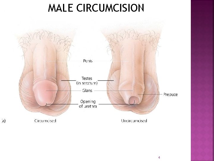 MALE CIRCUMCISION 4 