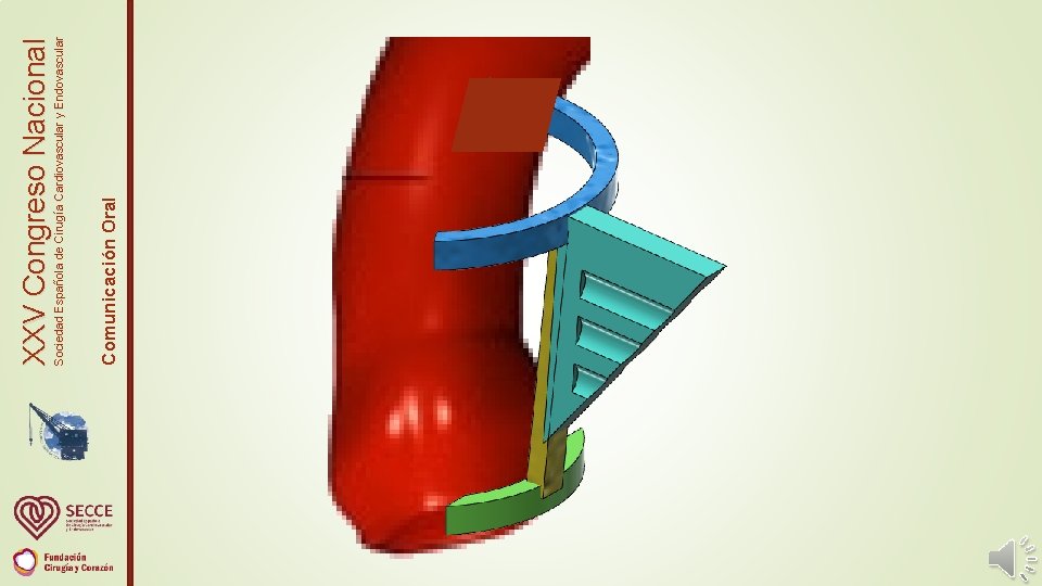 Comunicación Oral Sociedad Española de Cirugía Cardiovascular y Endovascular XXV Congreso Nacional 