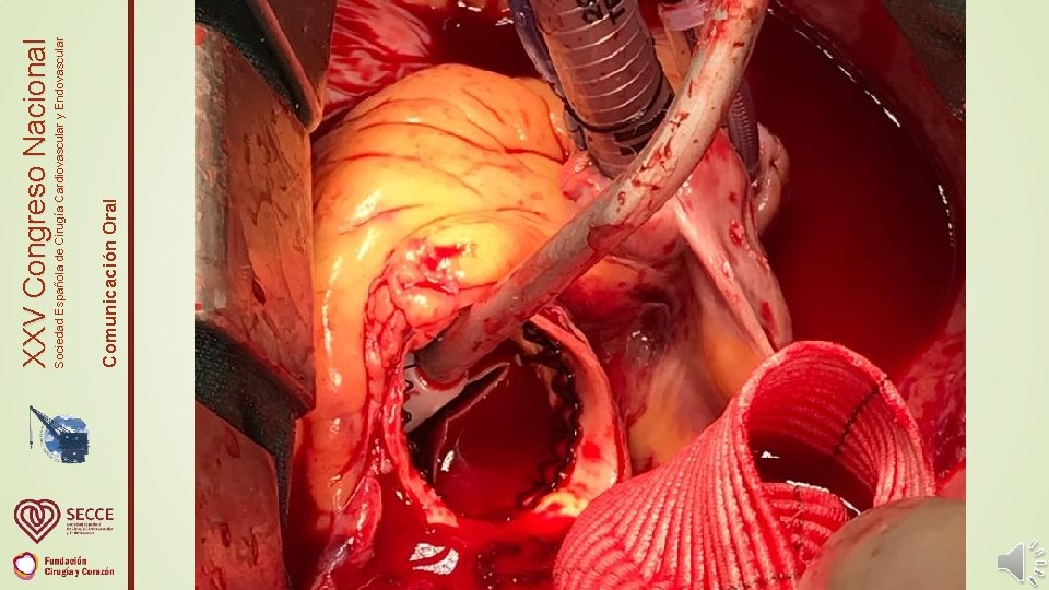 Comunicación Oral Sociedad Española de Cirugía Cardiovascular y Endovascular XXV Congreso Nacional 