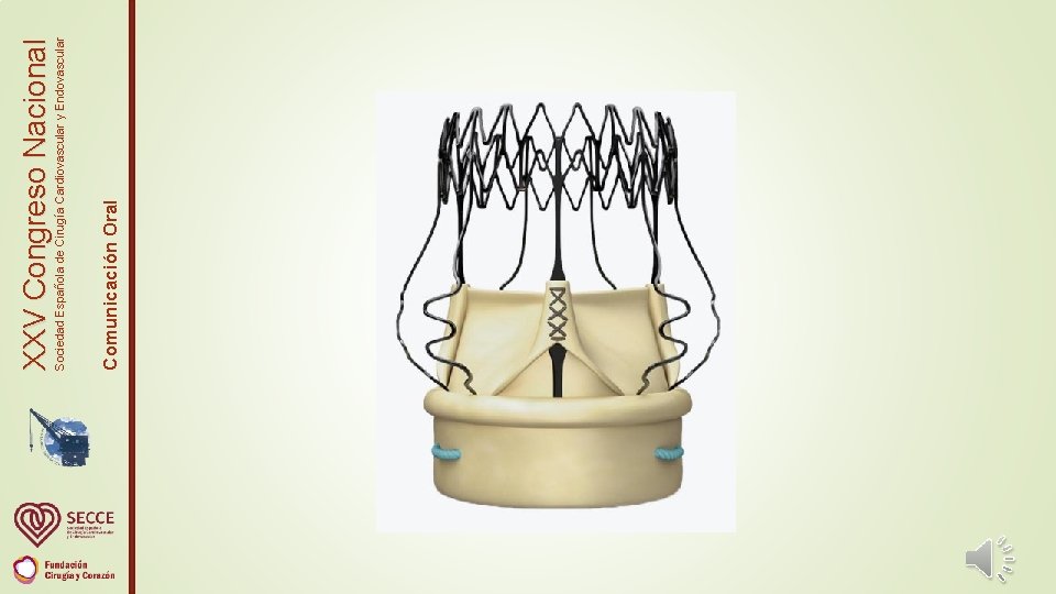 Comunicación Oral Sociedad Española de Cirugía Cardiovascular y Endovascular XXV Congreso Nacional 