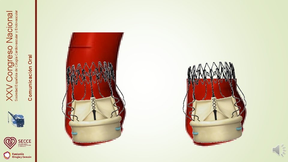 Comunicación Oral Sociedad Española de Cirugía Cardiovascular y Endovascular XXV Congreso Nacional 