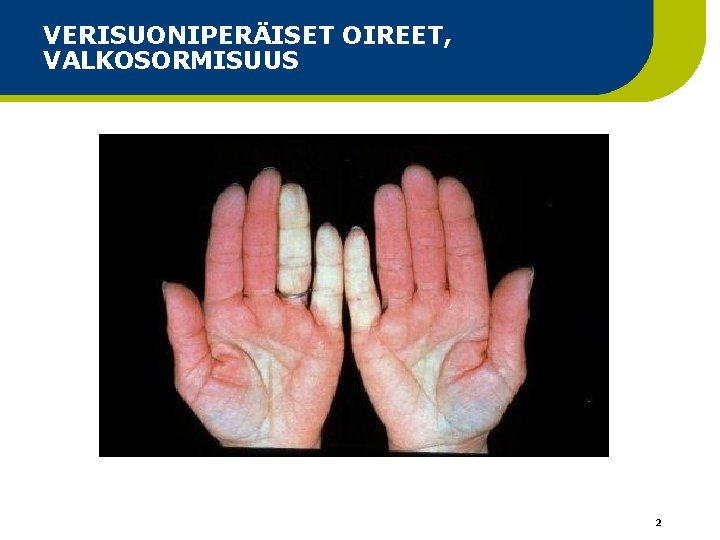 VERISUONIPERÄISET OIREET, VALKOSORMISUUS 2 VERISUONIPERÄISET OIREET, VALKOSORMISUUS 2