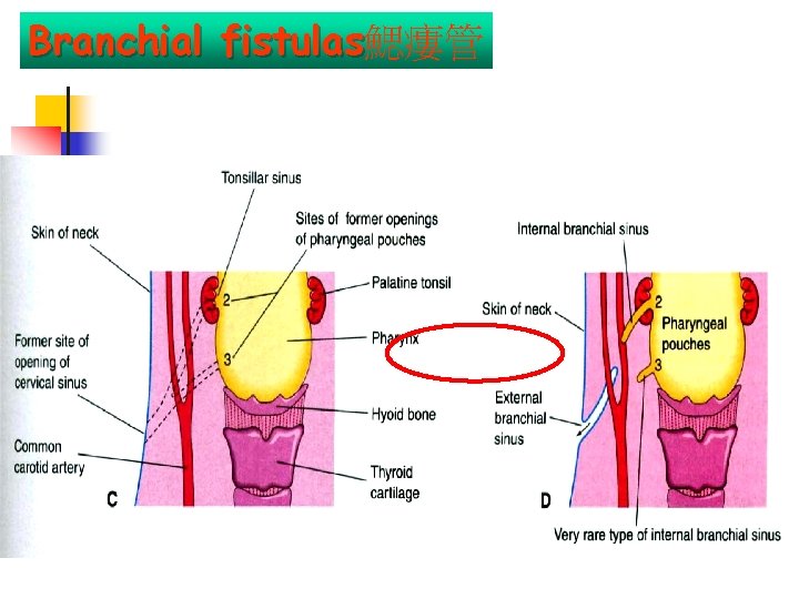 Branchial fistulas鰓瘻管 fistulas 