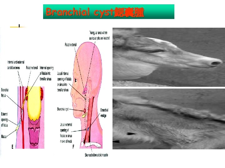 Branchial cyst鰓囊腫 