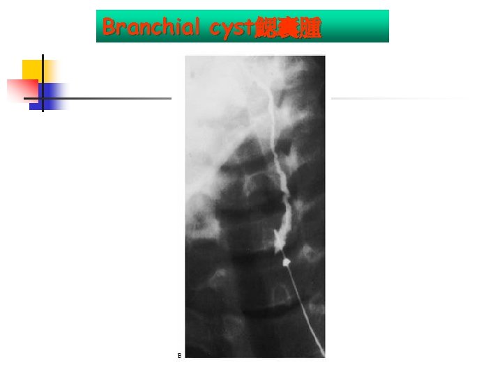 Branchial cyst鰓囊腫 