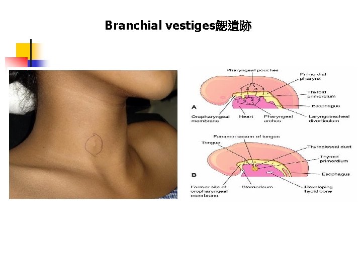 Branchial vestiges鰓遺跡 