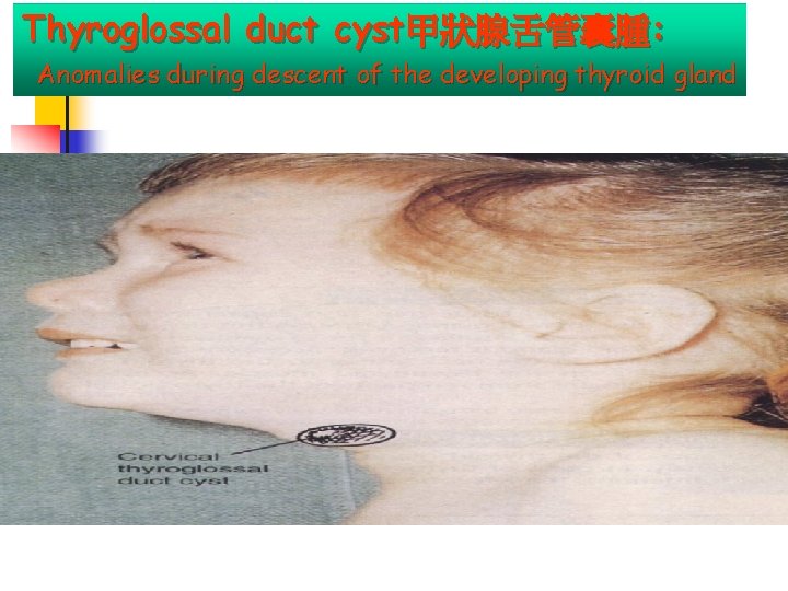 Thyroglossal duct cyst甲狀腺舌管囊腫: Anomalies during descent of the developing thyroid gland 