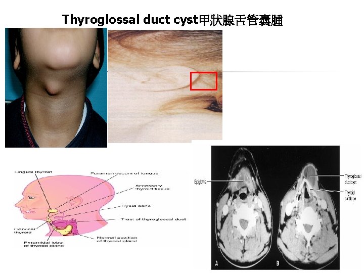 Thyroglossal duct cyst甲狀腺舌管囊腫 