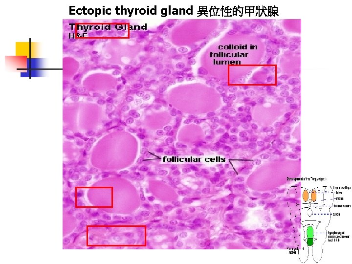 Ectopic thyroid gland 異位性的甲狀腺 
