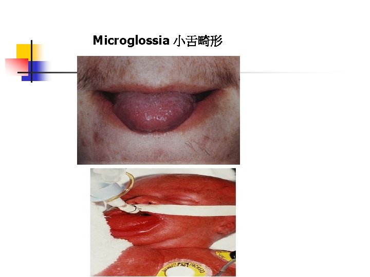 Microglossia 小舌畸形 