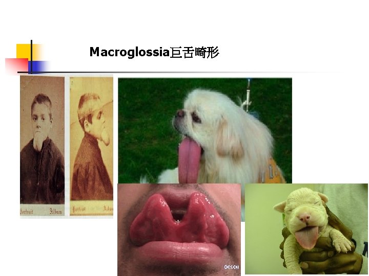 Macroglossia巨舌畸形 