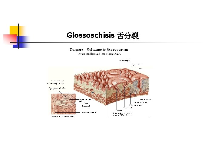 Glossoschisis 舌分裂 