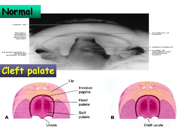 Normal Cleft palate 