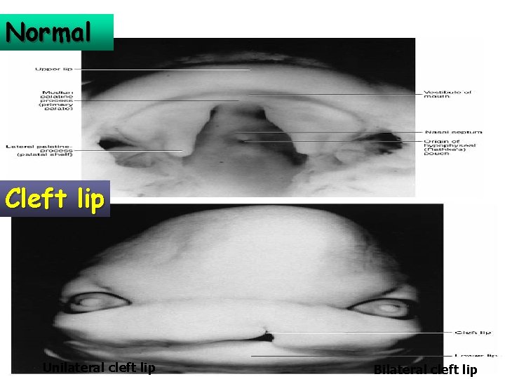 Normal Cleft lip Unilateral cleft lip Bilateral cleft lip 