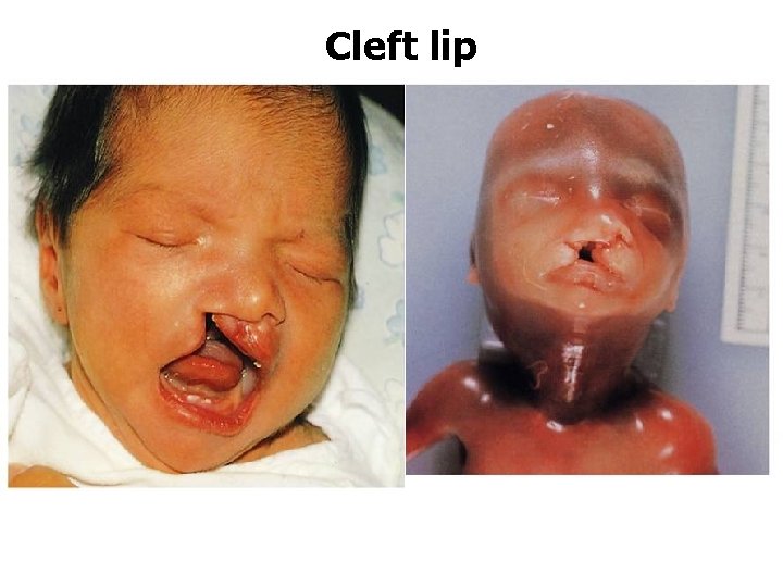 Cleft lip 