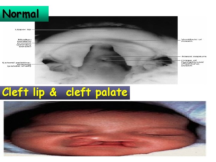 Normal Cleft lip & cleft palate 