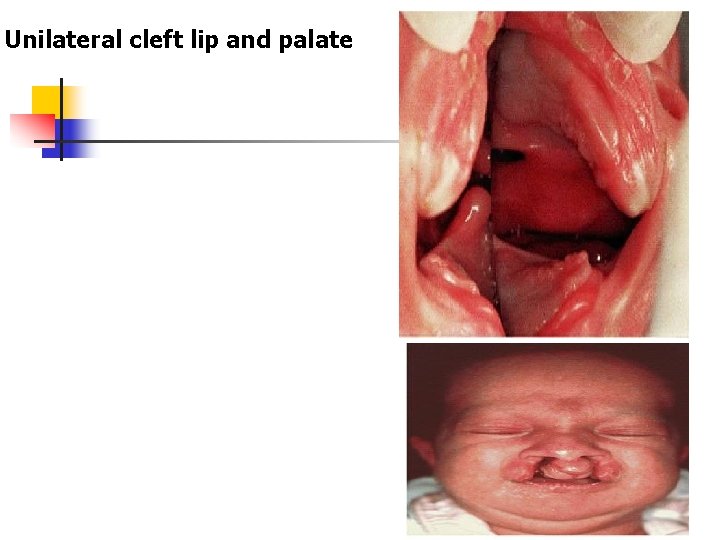 Unilateral cleft lip and palate 