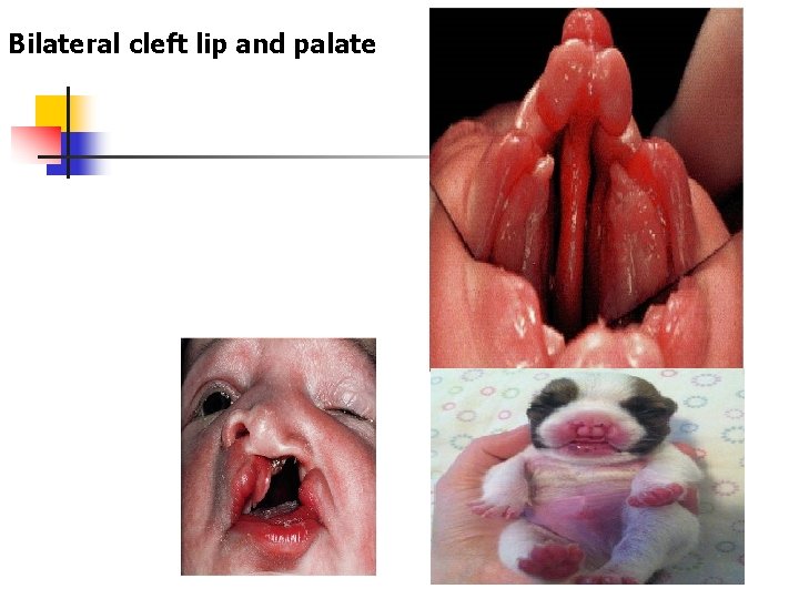 Bilateral cleft lip and palate 