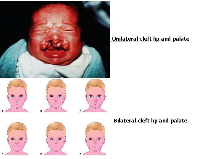 Unilateral cleft lip and palate Bilateral cleft lip and palate 