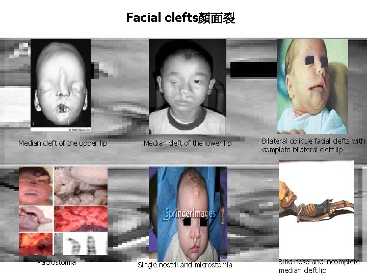Facial clefts顏面裂 Median cleft of the upper lip Macrostomia Median cleft of the lower