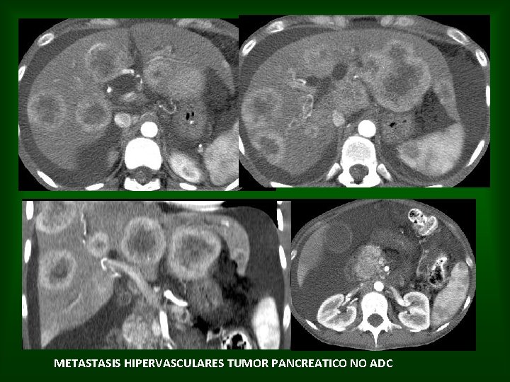 METASTASIS HIPERVASCULARES TUMOR PANCREATICO NO ADC 