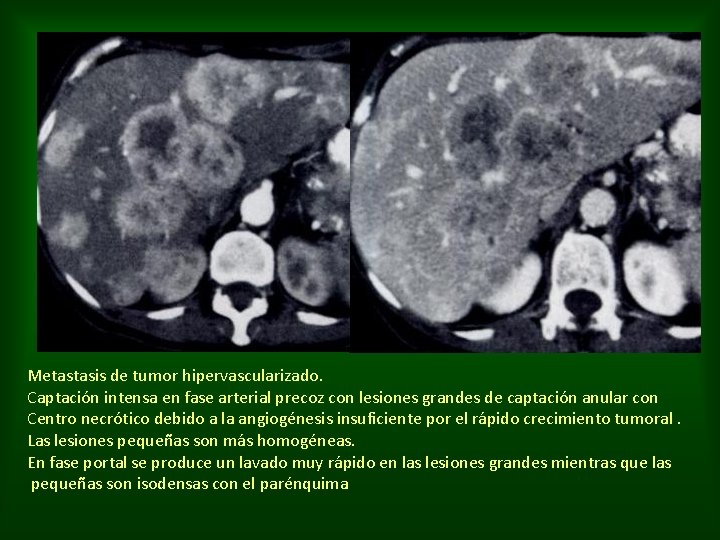 Metastasis de tumor hipervascularizado. Captación intensa en fase arterial precoz con lesiones grandes de