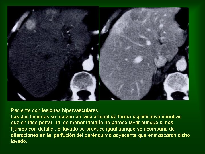 Paciente con lesiones hipervasculares. Las dos lesiones se realzan en fase arterial de forma