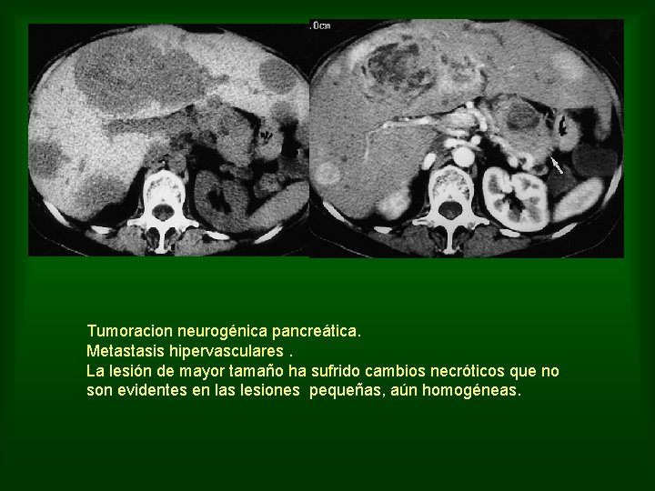 Tumoracion neurogénica pancreática. Metastasis hipervasculares. La lesión de mayor tamaño ha sufrido cambios necróticos
