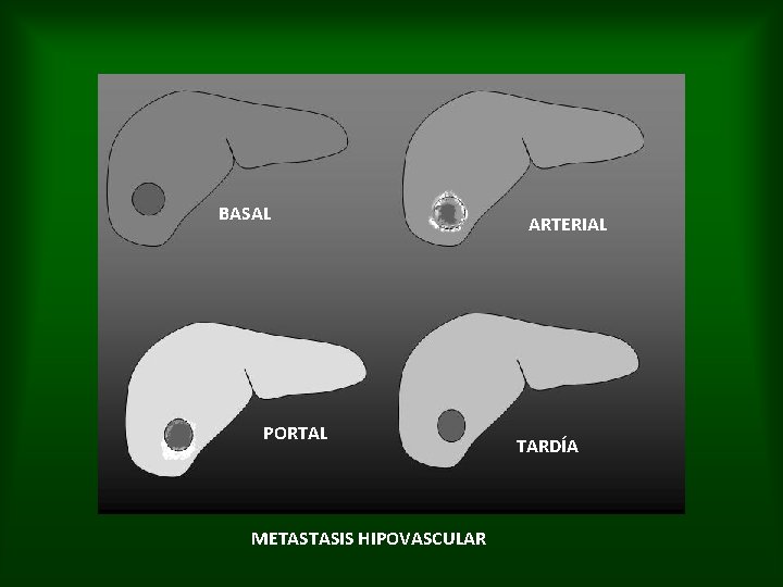 BASAL PORTAL METASTASIS HIPOVASCULAR ARTERIAL TARDÍA 