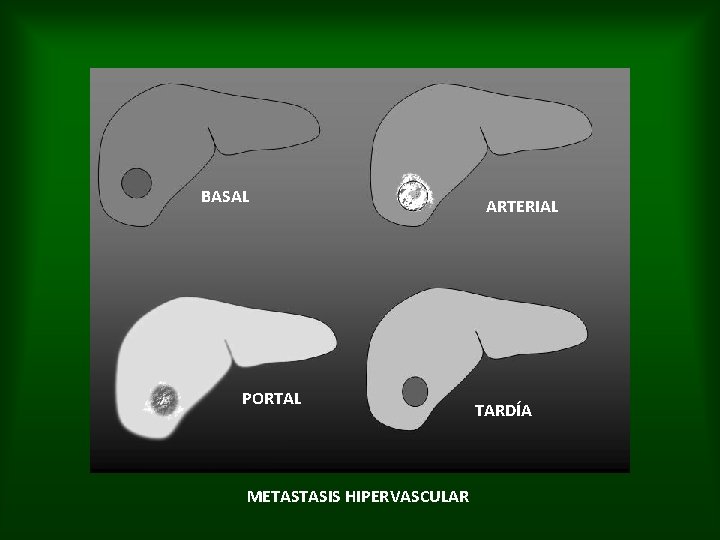 BASAL PORTAL METASTASIS HIPERVASCULAR ARTERIAL TARDÍA 