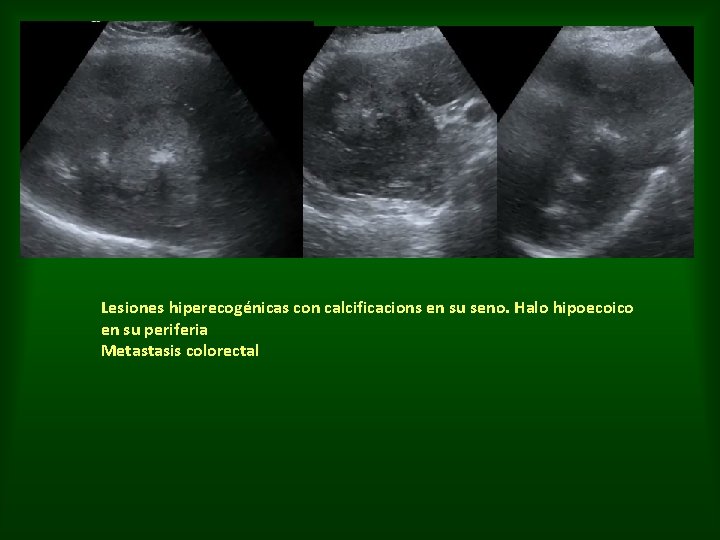 Lesiones hiperecogénicas con calcificacions en su seno. Halo hipoecoico en su periferia Metastasis colorectal