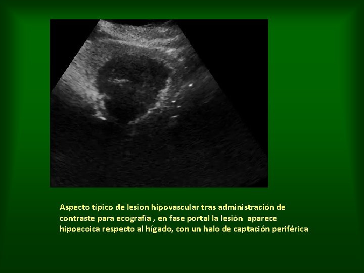 Aspecto típico de lesion hipovascular tras administración de contraste para ecografía , en fase