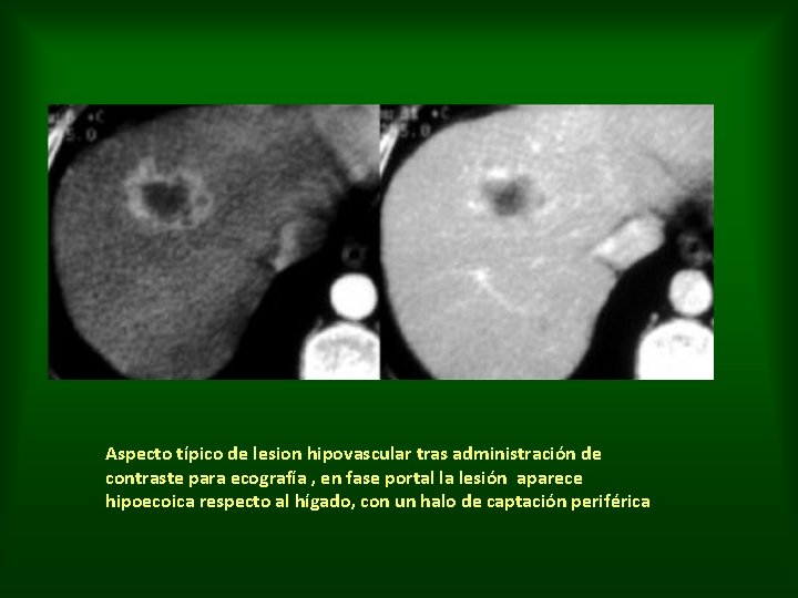 Aspecto típico de lesion hipovascular tras administración de contraste para ecografía , en fase