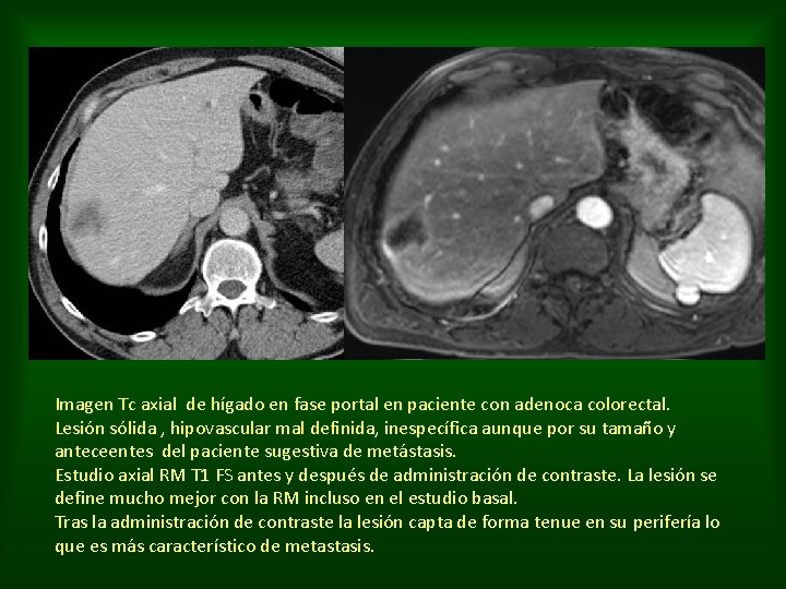 Imagen Tc axial de hígado en fase portal en paciente con adenoca colorectal. Lesión