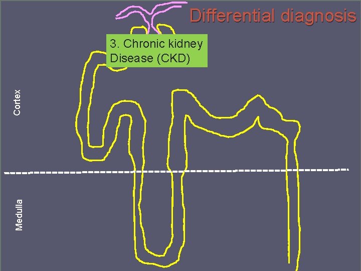 Differential diagnosis Medulla Cortex 3. Chronic kidney Disease (CKD) Denmark September 2014 