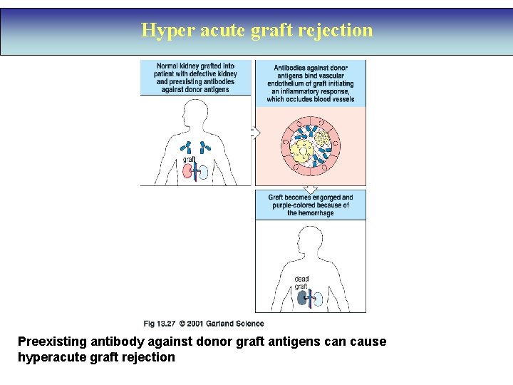 Hyper acute graft rejection Preexisting antibody against donor graft antigens can cause hyperacute graft