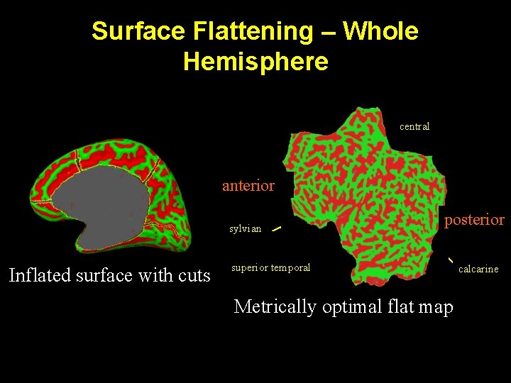 Surface Flattening – Whole Hemisphere central anterior sylvian Inflated surface with cuts posterior superior