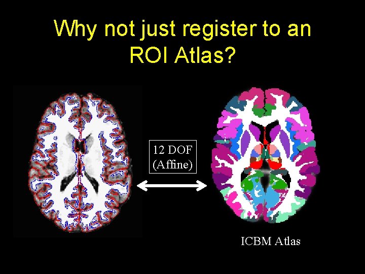 Why not just register to an ROI Atlas? 12 DOF (Affine) ICBM Atlas 